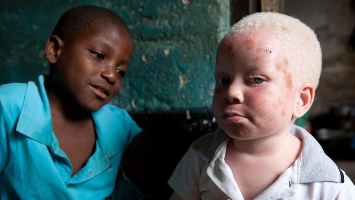 Albínský chlapec v Tanzánii