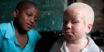 VIDEO: Albíny v Africe by před zmrzačením měly chránit alarmy, ty ale nefungují