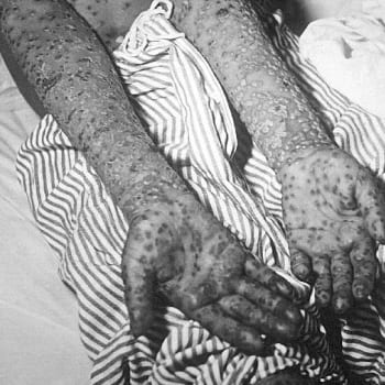 Jugoslávii sužovaly v roce 1972 neštovice.