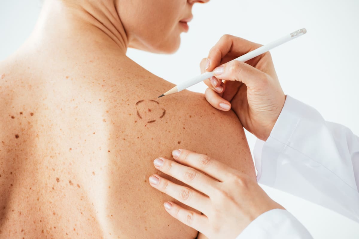 Mýty o rakovině kůže, které vám mohou uškodit.