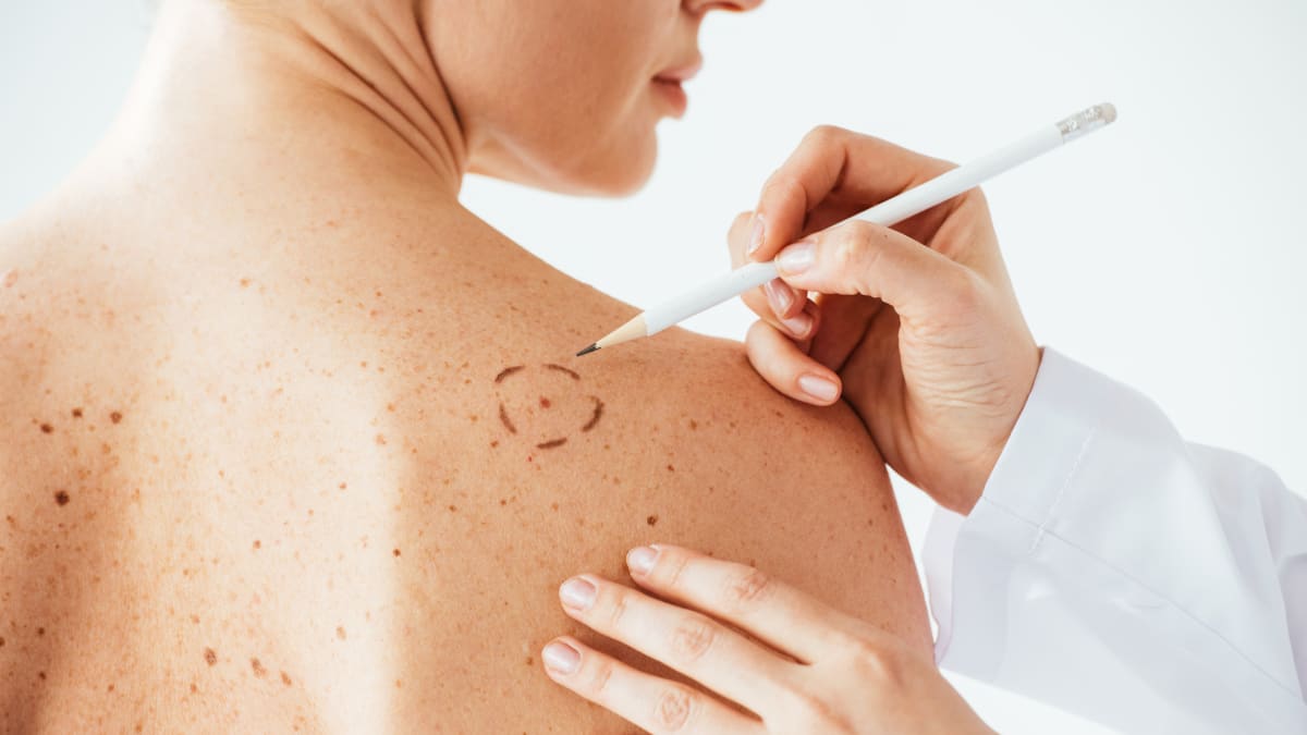Mýty o rakovině kůže, které vám mohou uškodit.