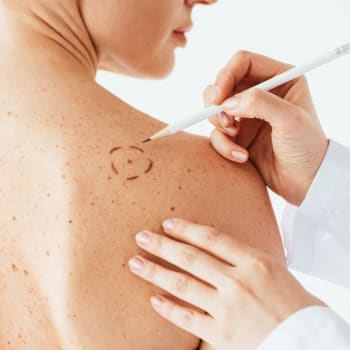 Mýty o rakovině kůže, které vám mohou uškodit