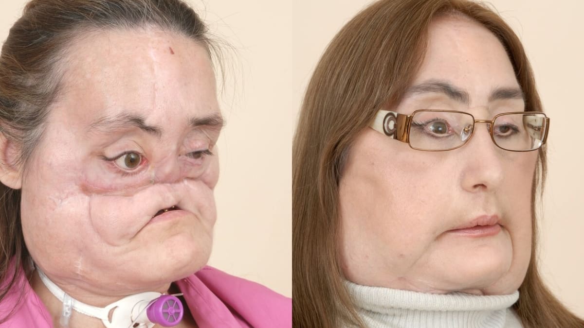 Connie Culpová před a po transplantaci obličeje