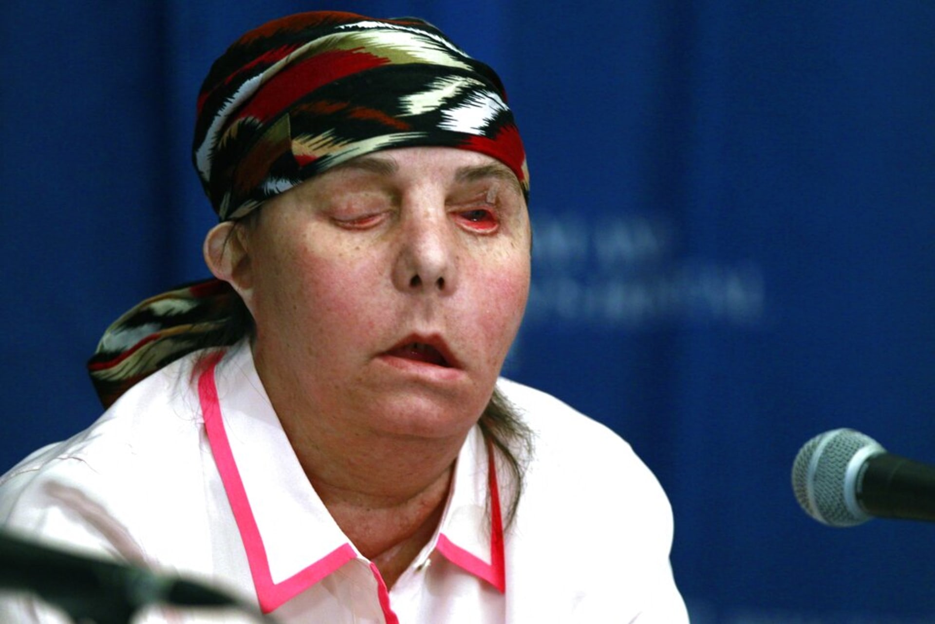 Carmen Tarletonová v roce 2013 po první transplantaci obličeje