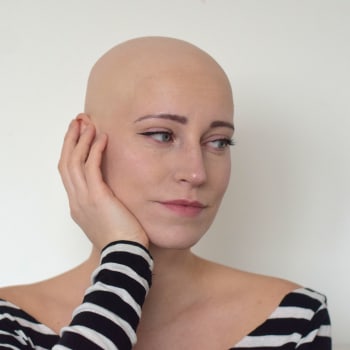 Blanka Pelcová alopecií typu univerzalis trpí už devět let.