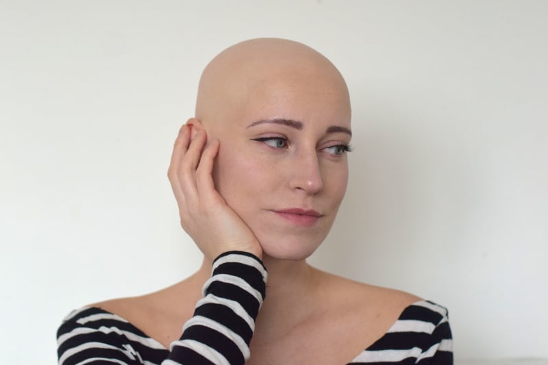 Blanka Pelcová alopecií typu univerzalis trpí už jedenáct let.