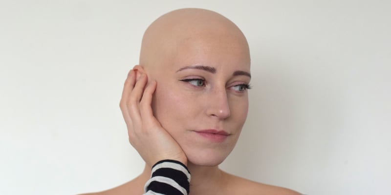 Blanka Pelcová alopecií typu univerzalis trpí už jedenáct let.