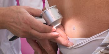 Dermatologové: Nechte si zdarma vyšetřit znaménka, riziko zhoubného melanomu stoupá