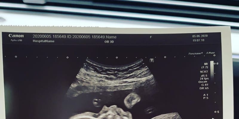 Tammy sdílela na Instagramu ultrazvuk jejich dítěte ve 34. týdnu. 