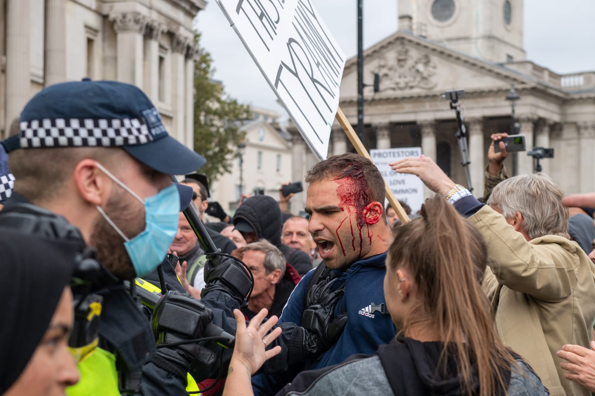 Muž se zakrváceným obličejem protestuje spolu s dalšími demonstranty proti přísným koronavirovým opatřením v Londýně. Po střetech museli být ošetřeni tři demonstranti a jeden policista.