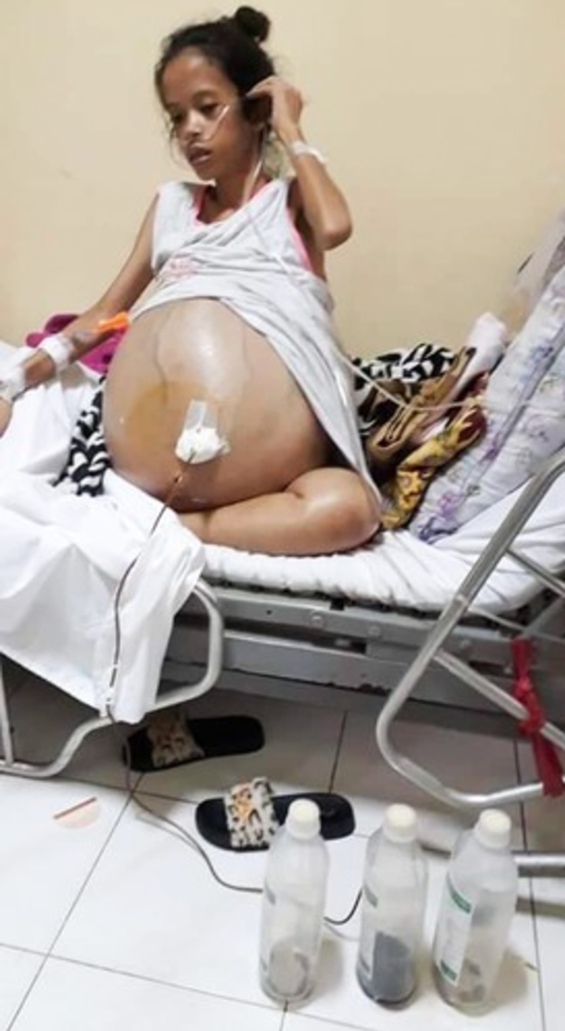 Vypadalo to, že je těhotná. Nellyn Joy Amasová má v těle nádory vážící 90 kg.