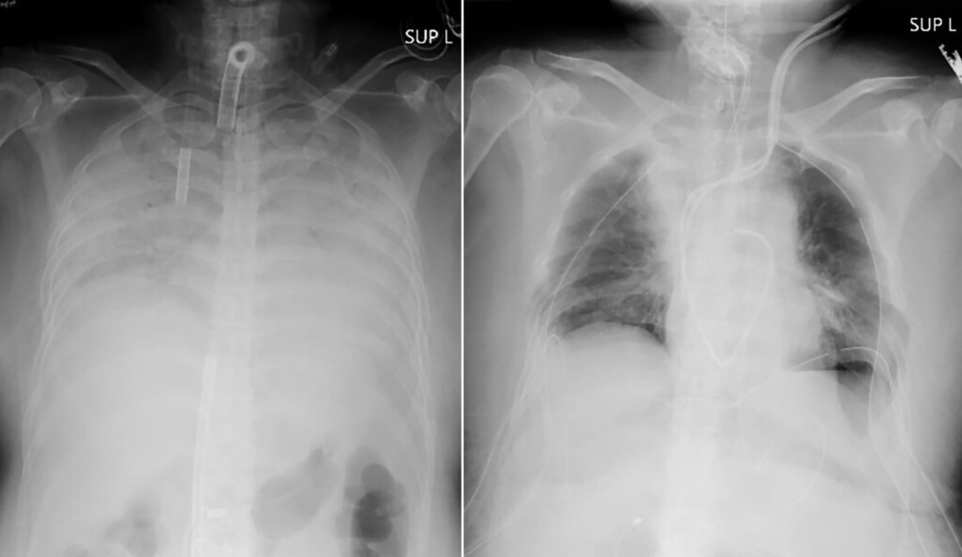 Rentgenové snímky ukazují hrudník pacientky před operací (vlevo) a po ní (vpravo).