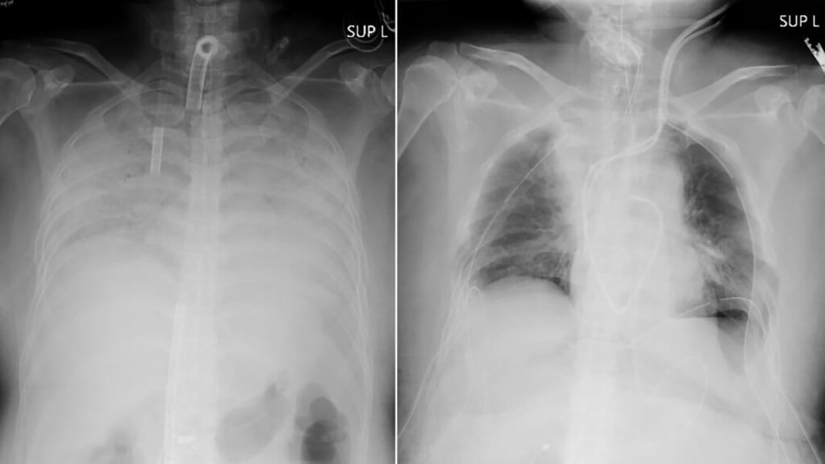 Rentgenové snímky ukazují hrudník pacientky před operací (vlevo) a po ní (vpravo).