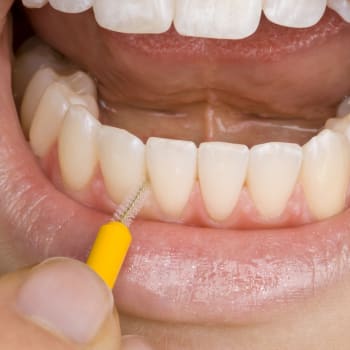 Lidé mohou periodontitidě předejít důkladnou dentální hygienou, včetně každodenního čištění mezizubním kartáčkem a pravidelnými návštěvami zubního lékaře. (Ilustrační snímek)