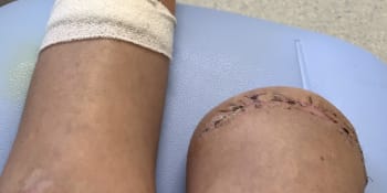 Tragický omyl kousek od hranic: Lékaři v Rakousku amputovali pacientovi nesprávnou nohu