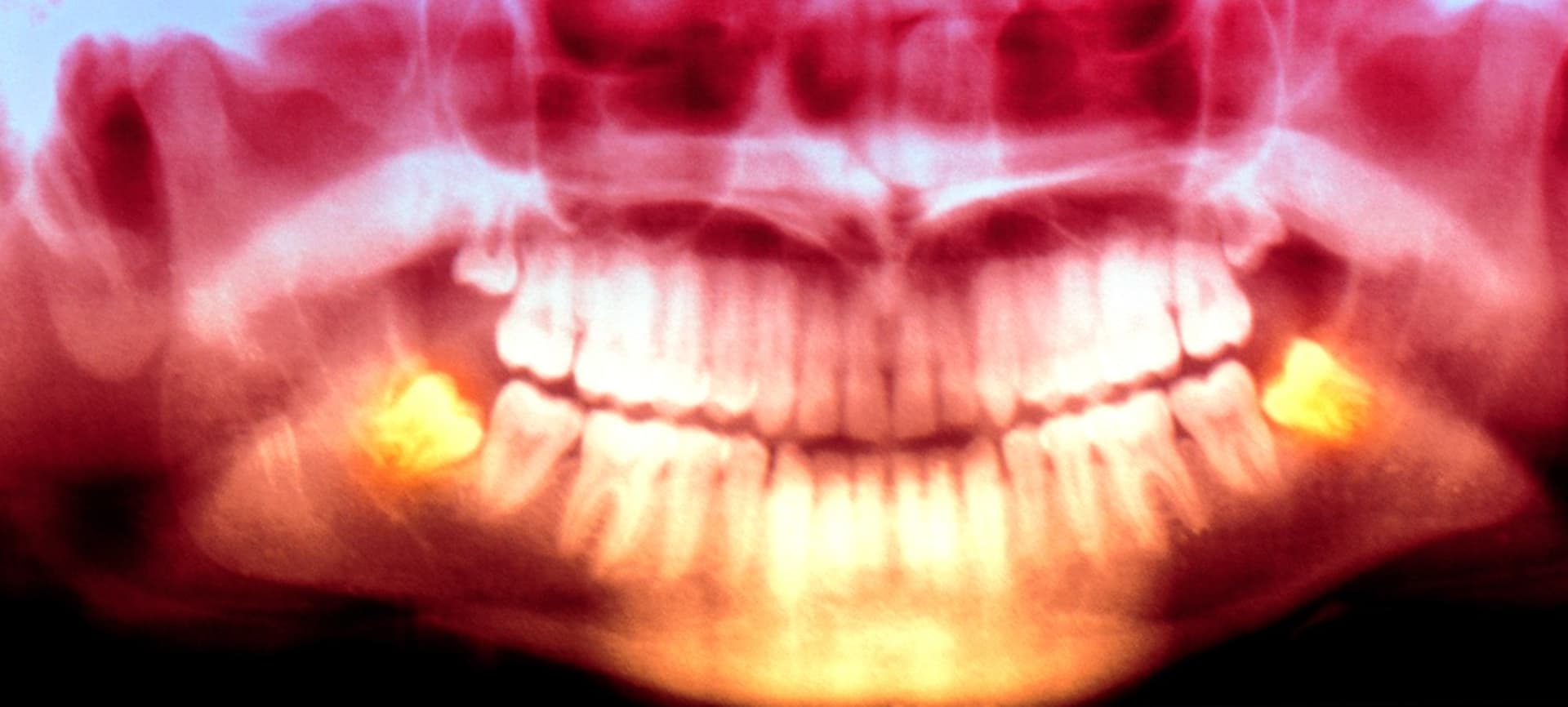 Vědci z Arizonské univerzity zřejmě vyřešili otázku, proč lidem rostou zuby moudrosti až na prahu dospělosti.