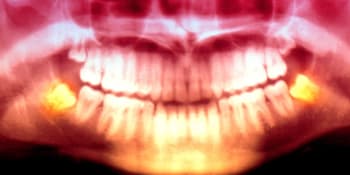 Vědci objasnili záhadu. Proč lidem rostou zuby moudrosti až na prahu dospělosti?