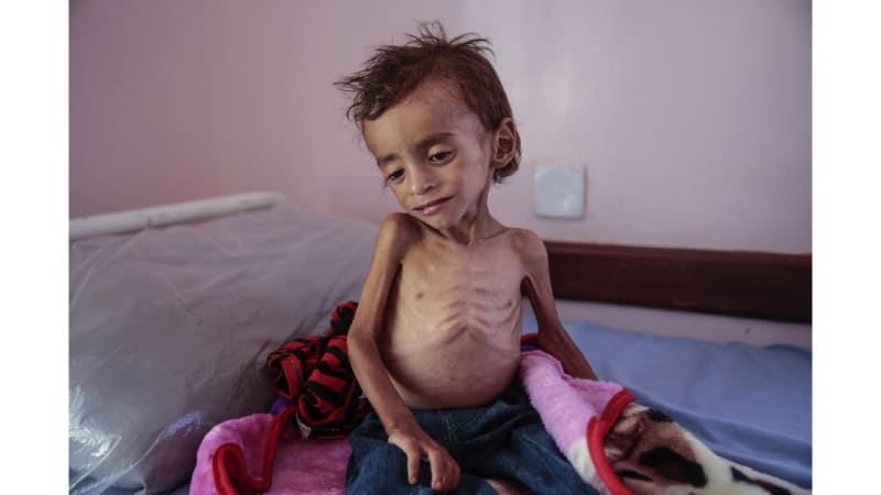 Hladomor v Jemenu ohrožuje asi 2,3 milionu dětí do pěti let, asi 400 tisíc dětí už je v kritickém stavu. Snímek poskytl spolek Pomůžu jak můžu.