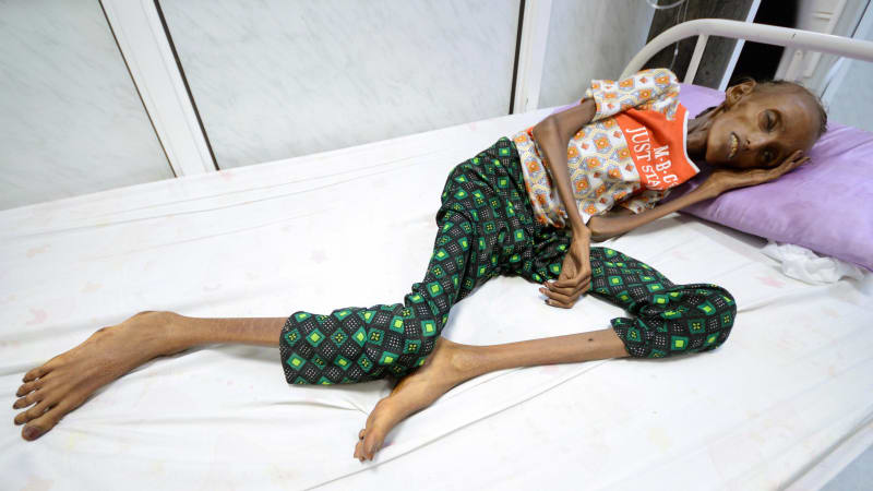 Hladomor v Jemenu ohrožuje přes dva miliony dětí do pěti let, asi 400 tisíc dětí už je v kritickém stavu. Snímek poskytl spolek Pomůžu jak můžu.