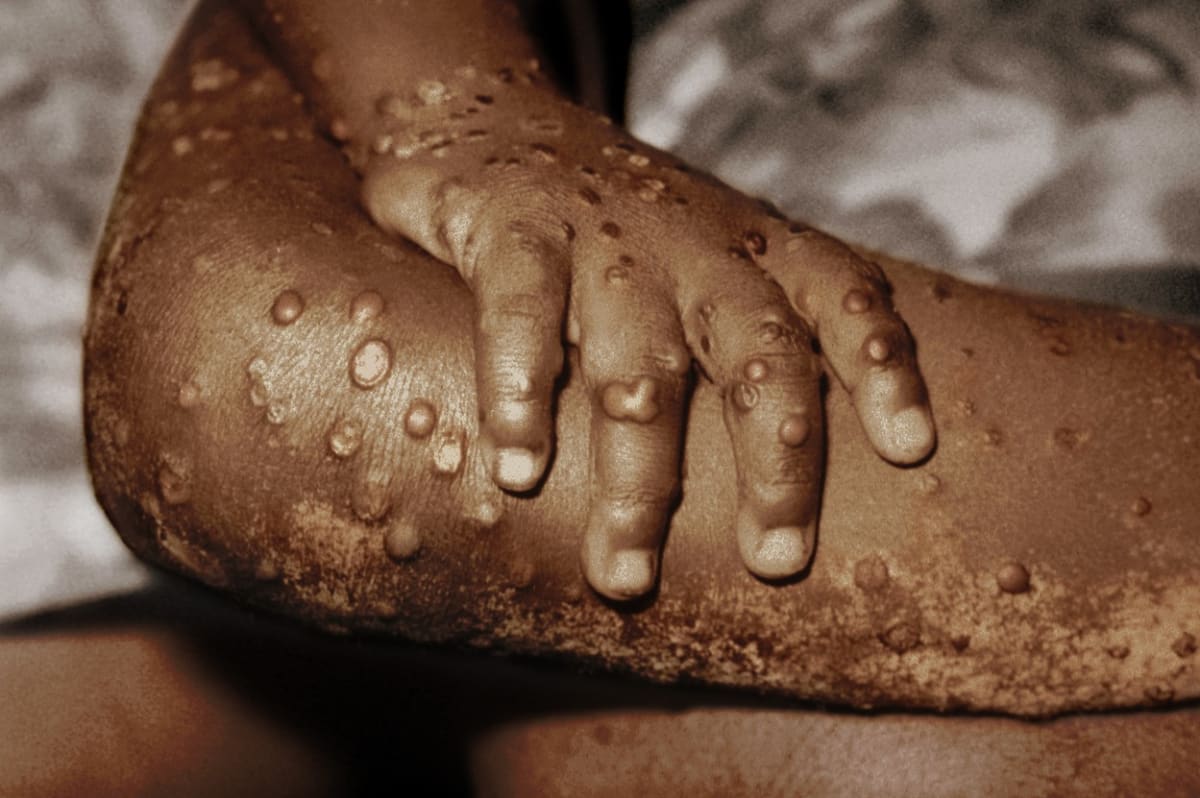 Nákaza se projevuje podobně jako běžné neštovice, byť s mírnějšími příznaky.