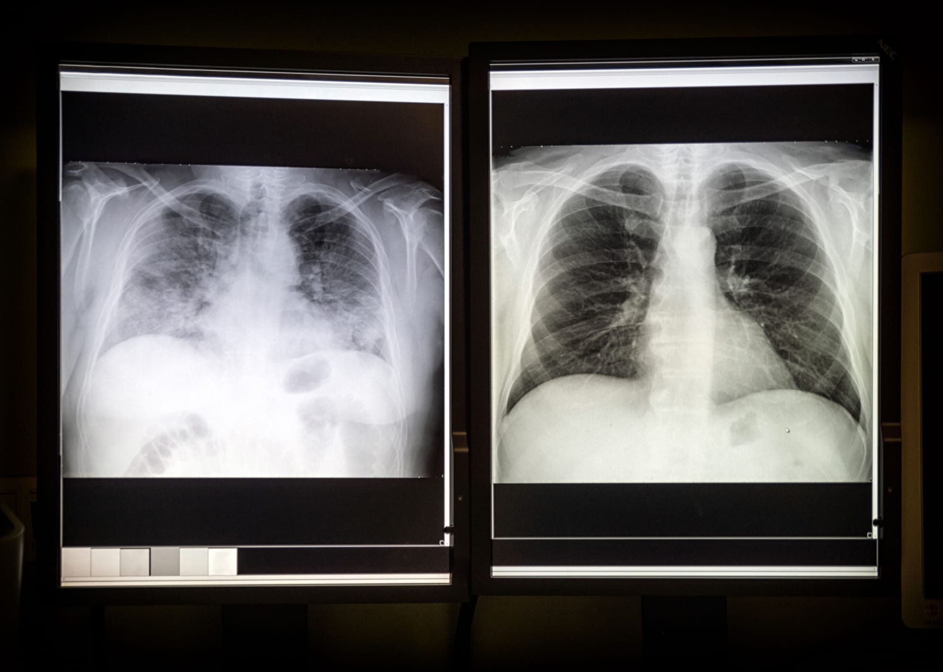 Postcovid může souviset se skrytým poškozením plic.