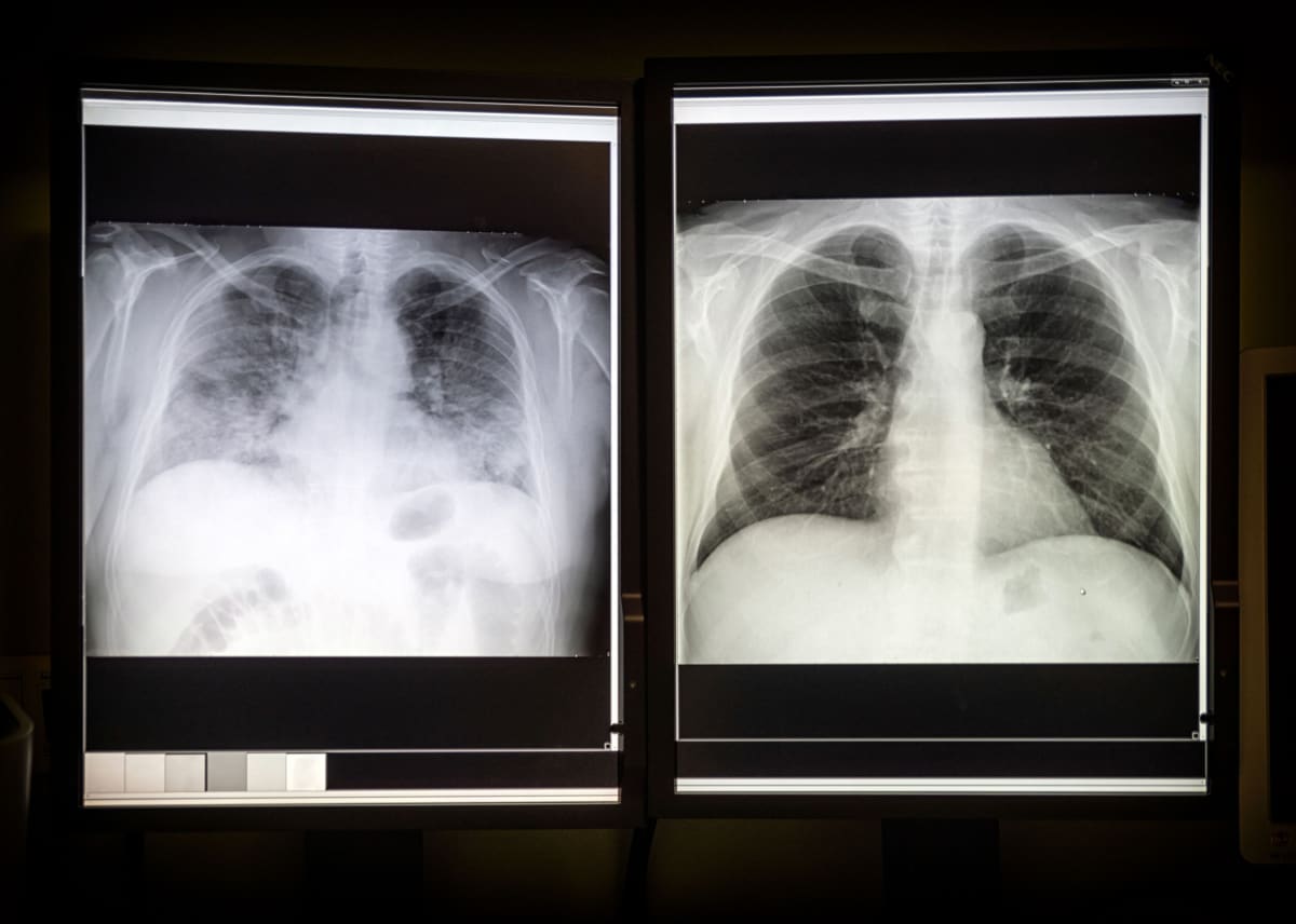 Covid v řadě případů nenávratně poškodí plíce pacientů (levý snímek). Zdravé plíce by měly být na rentgenu tmavé (pravý snímek).