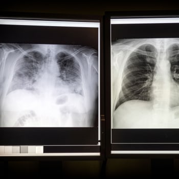 Covid v řadě případů nenávratně poškodí plíce pacientů (levý snímek). Zdravé plíce by měly být na rentgenu tmavé (pravý snímek).