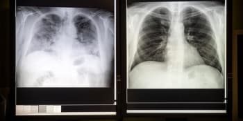 Hrůzné snímky plic neočkovaných s covidem: Lékař posílá lidem varovný vzkaz