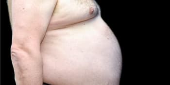 Obézní lidé jsou semeništěm viru. Kvůli tuku covid hůře zvládají, tvrdí výzkum