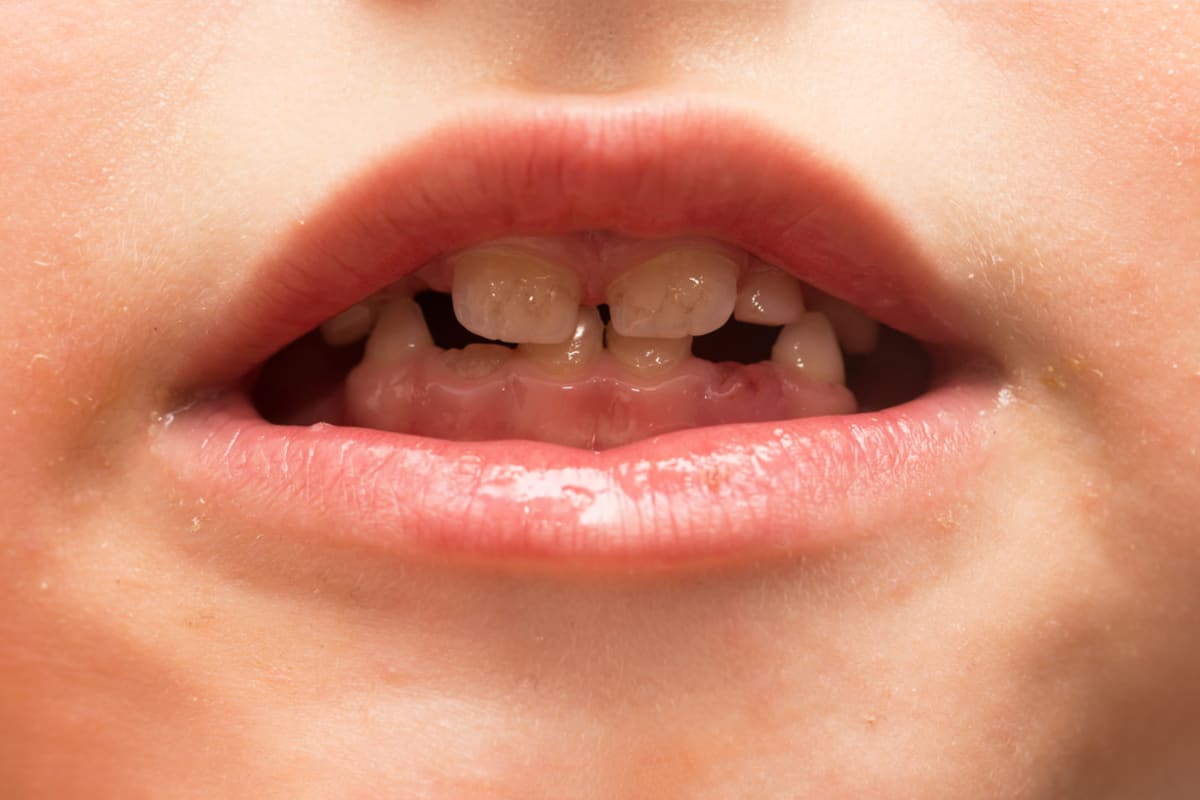 Georgia Hughesová si všimla, že jejímu tříletému synovi Mylesovi chybí několik zubů, a obrátila se na lékaře. (Ilustrační foto)
