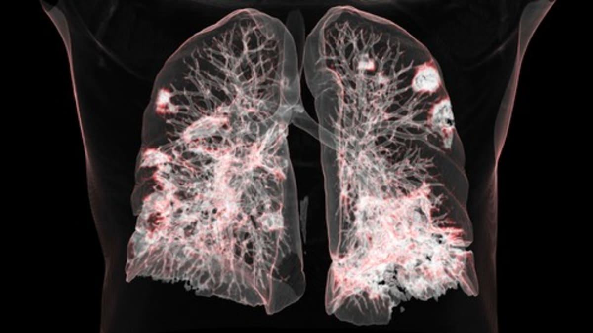 Snímek plic člověka s covidem