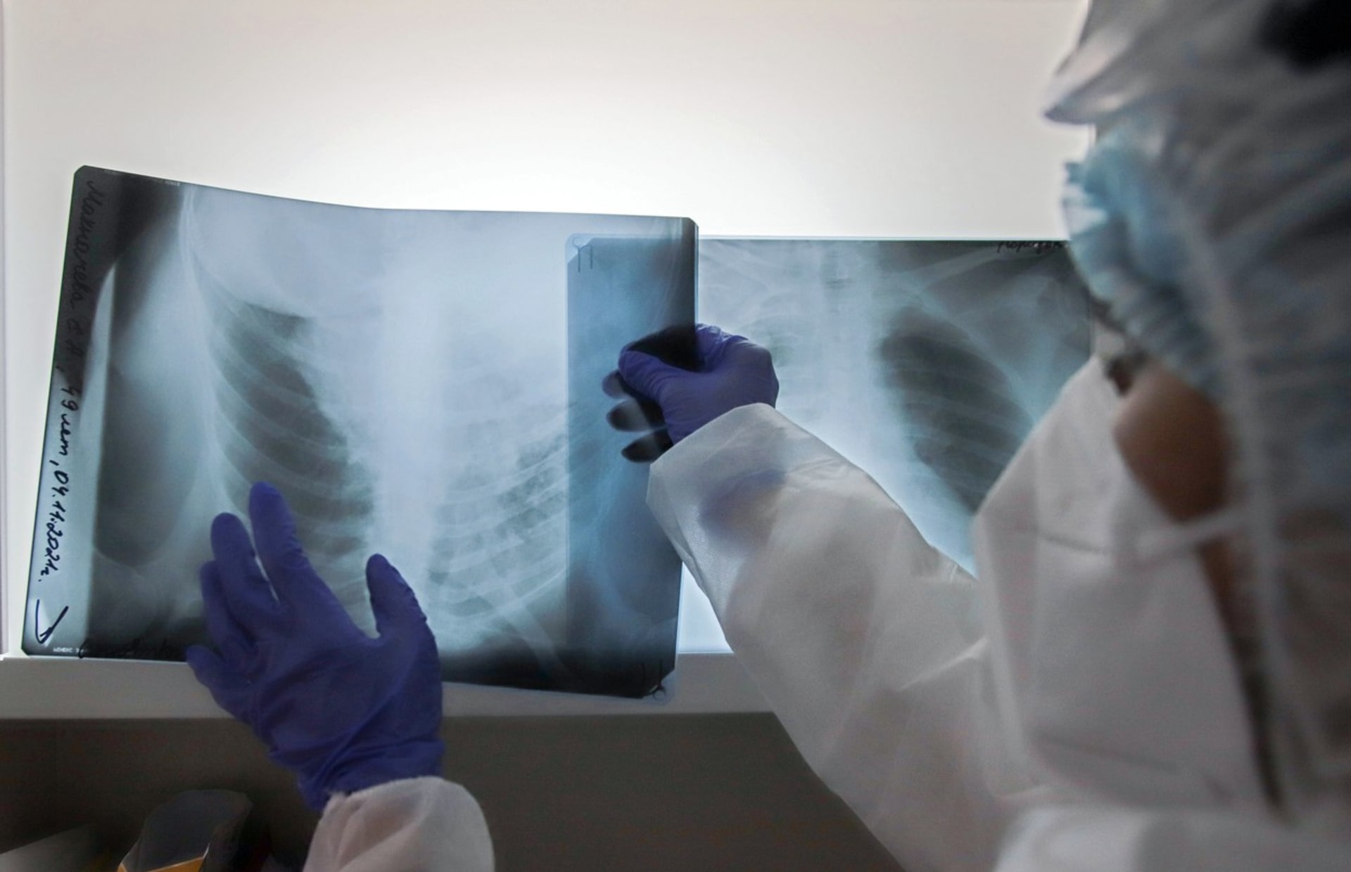 Rentgenový snímek plic pacienta s covidem