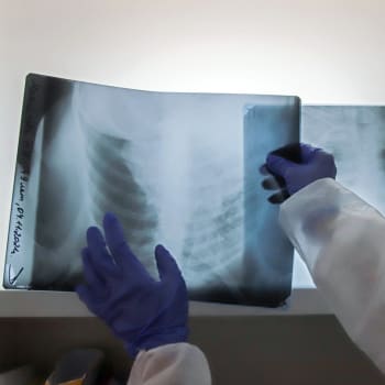 Rentgenový snímek plic pacienta s covidem