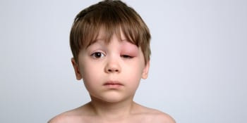 Chlapec skončil s „covidovým okem“ v nemocnici. Lékaři se obávali, že přijde o zrak