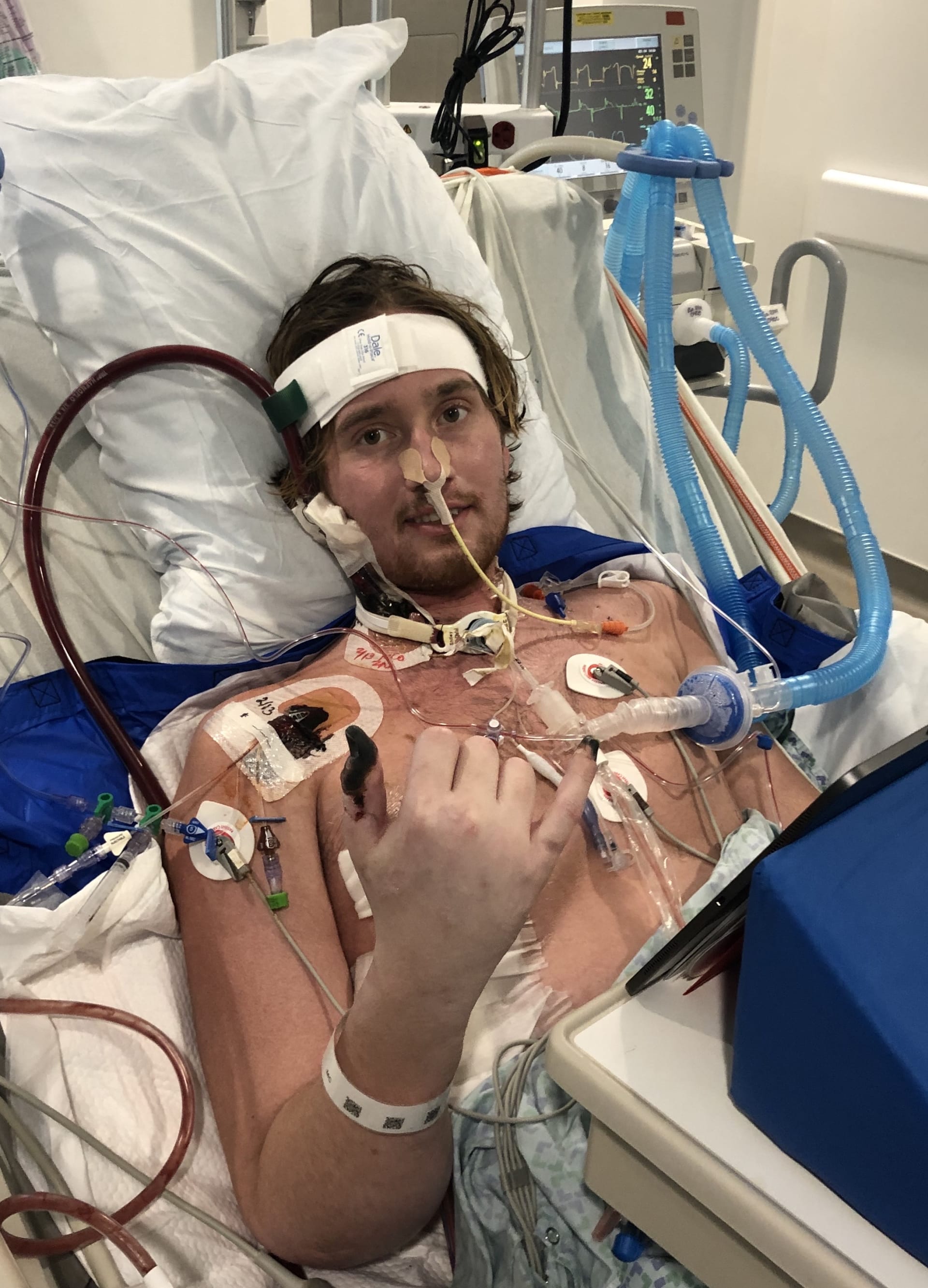 Surfař Carter Parry absolvoval 30 operací, lékaři mu museli amputovat nohu a odebrat jednu plíci.