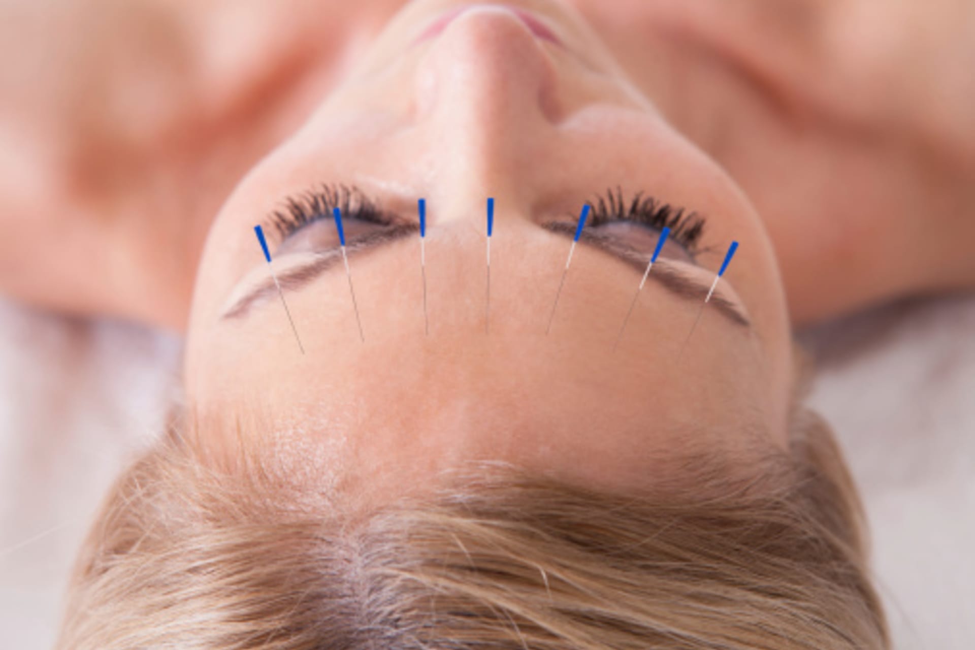 Kosmetická akupunktura je šetrný a velmi účinný způsob, jak se zbavit vrásek