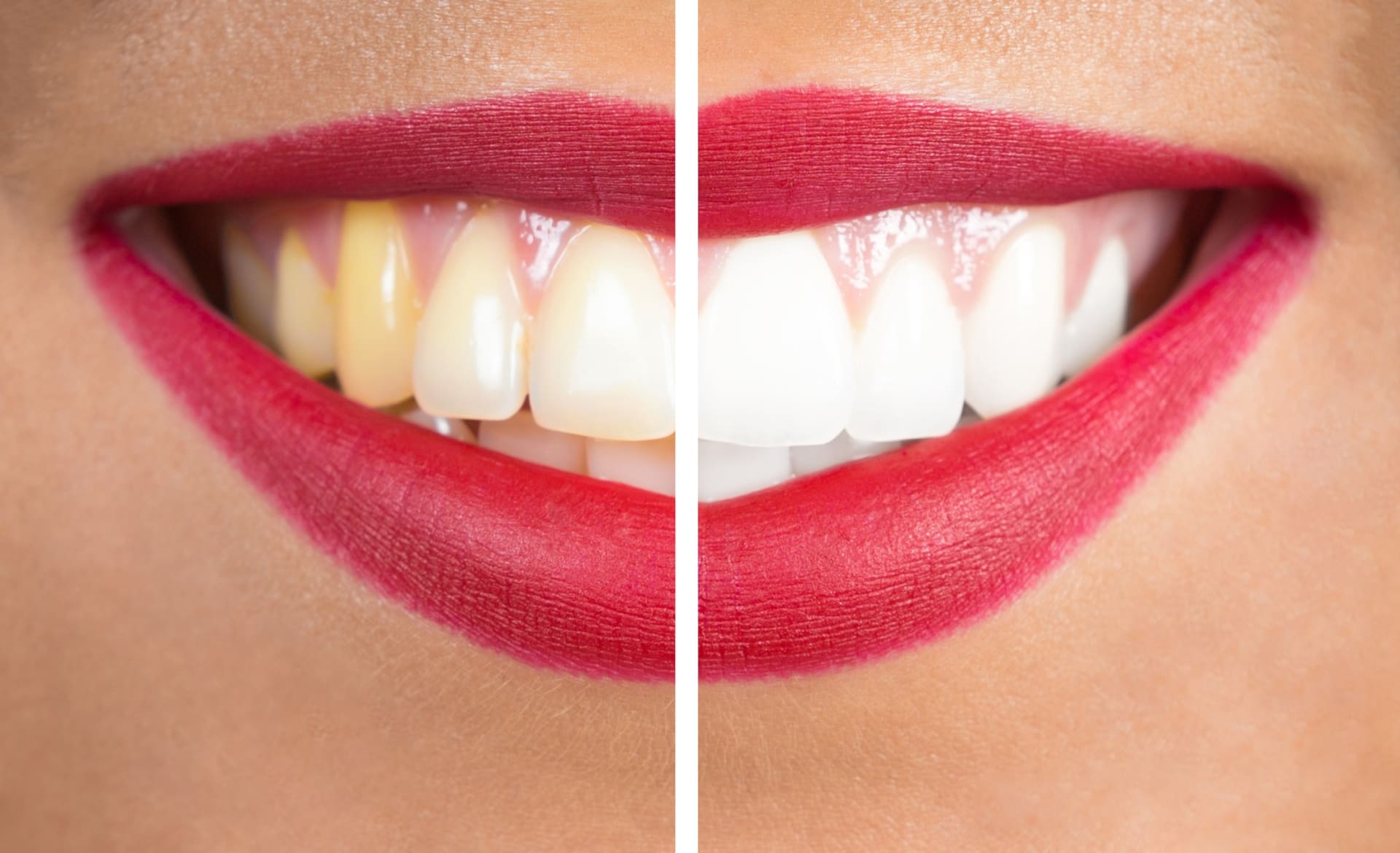 Zubní kámen dokáže potrápit. Jak ho odstranit a čeho se vyvarovat?