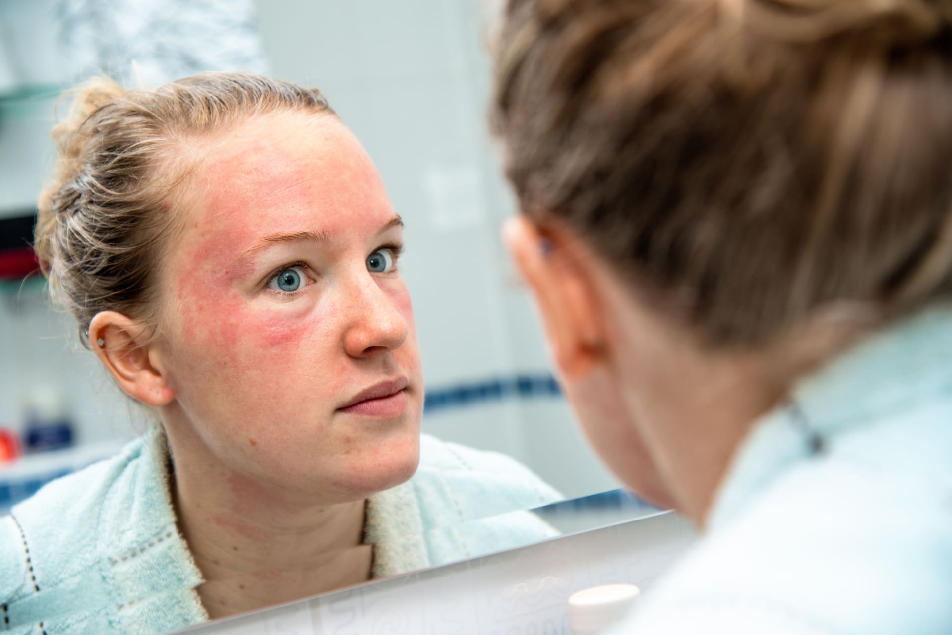 Periorální dermatitida může vyústit v další kožní nemoc, tzv. růžovku