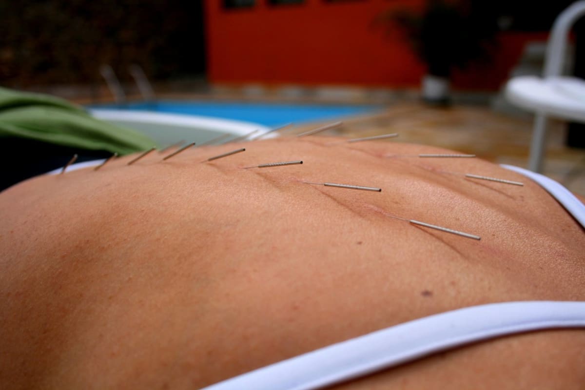 Akupunktura prý nebolí