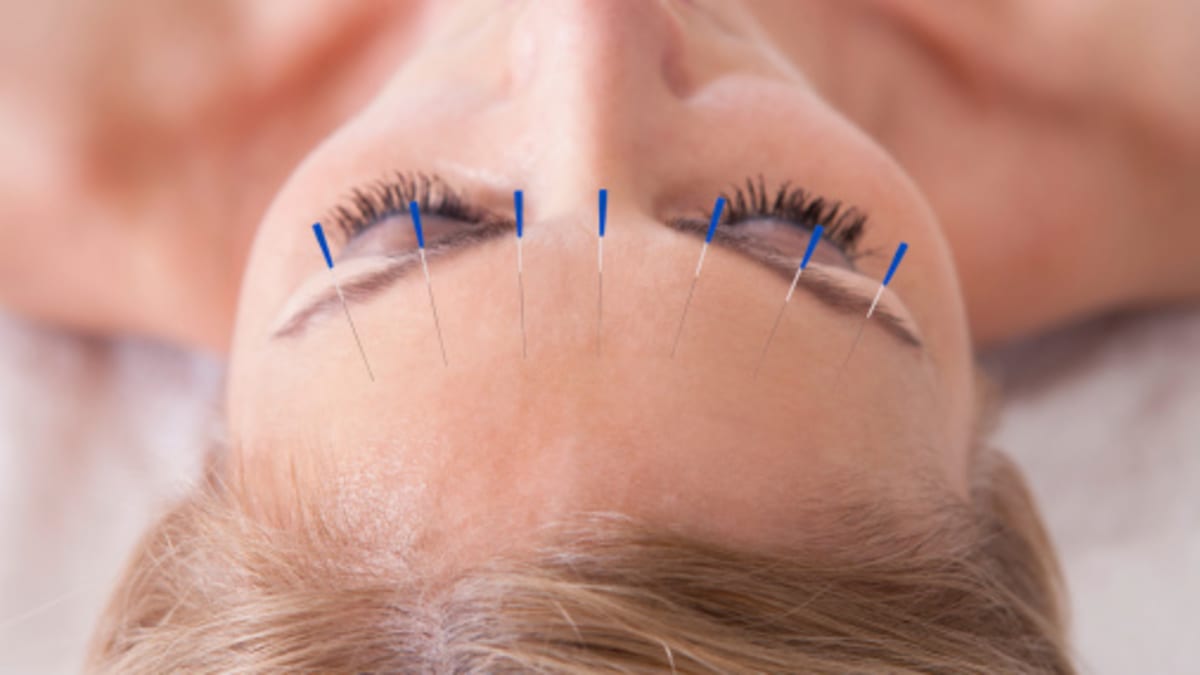 Kosmetická akupunktura je šetrný a velmi účinný způsob, jak se zbavit vrásek