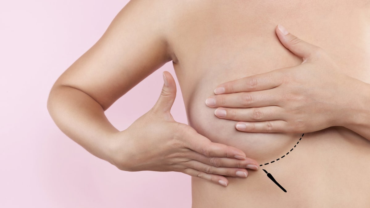 Plastika prsou - změnily se hlavně implantáty