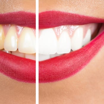 Zubní kámen dokáže potrápit. Jak ho odstranit a čeho se vyvarovat?