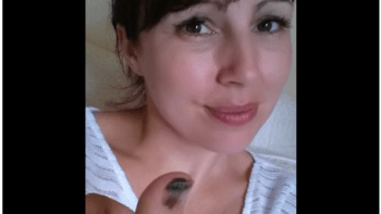 Žena sdílí fotografii své rakoviny kůže jako varování!
