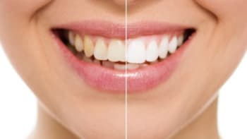 ONLINE CHAT: Ptejte se zubního lékaře a odborníka na bělení zubů dr. Alexeje Bilouse