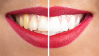 Zubní kámen dokáže potrápit. Jak ho odstranit a čeho se vyvarovat?
