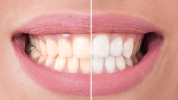 5 způsobů, jak si vybělit zuby doma a (skoro) zadarmo