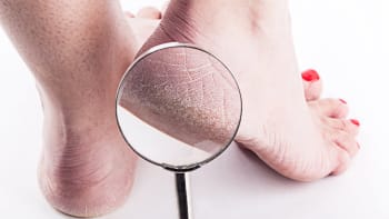 7 důvodů, proč vaše kůže na nohou praská a odlupuje se