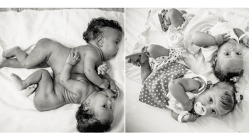 11 dojemných fotografií: Siamská dvojčátka před a po operaci!