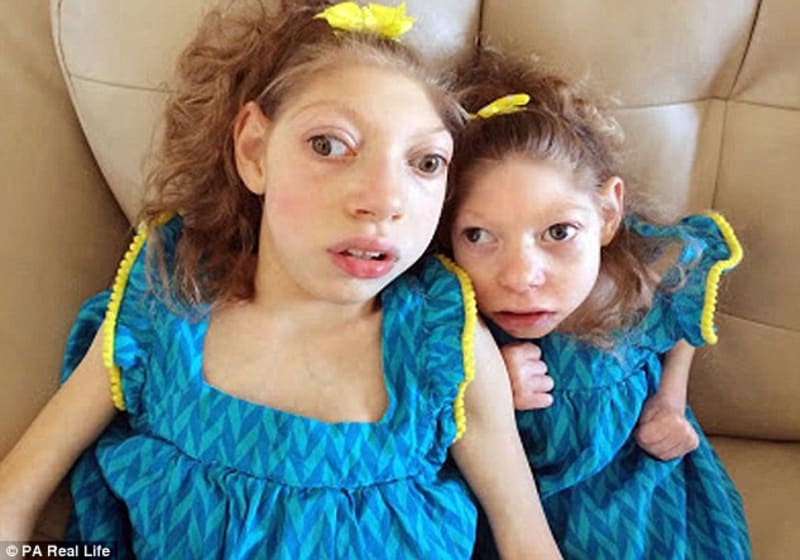 Claire a Lola – dívky, jejichž život ovlivnil virus zika - Obrázek 14