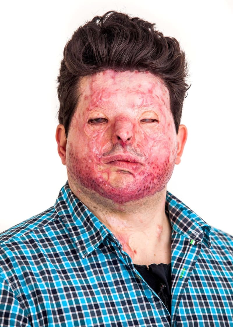 Andreas Christopheros - Muž s poleptaným obličejem od kyseliny - Obrázek 5